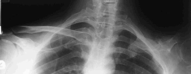 Claviculoplasty x-ray Pre-op.jpg (329283 bytes)